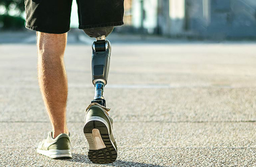 A person walking with a prosthetic leg. 